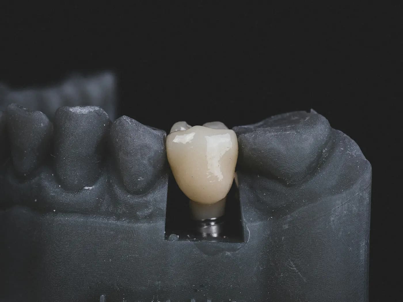 Implant sa krunicom na modelu